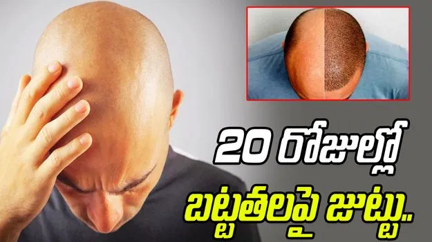 Hair Regrow Serum: బట్టతల ఉన్న వారికి శుభవార్త.. ఈ సీరమ్ 20 రోజుల్లో జుట్టు మొలిపిస్తుంది..