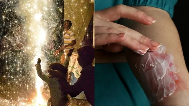  Diwali Injury Prevention Tips:  దీపావళి క్రాకర్స్ కాల్చడం వల్ల చేతులు, కాళ్లకు గాయాలయ్యాయా? ఇలా చేయండి..