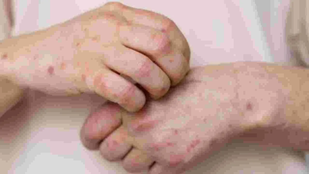 Fungal Infections: ఫంగల్ ఇన్ఫెక్షన్లు ఎందుకు వస్తాయో మీకు తెలుసా? 