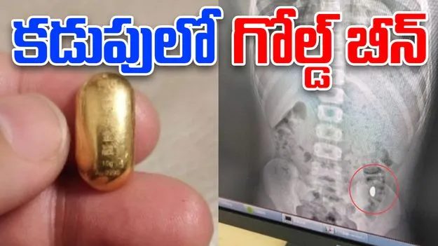 Boy Swallows Gold Bean: గోల్డ్ బీన్ మింగేసిన బాలుడు.. ఐదు రోజులు అయినా కూడా.. 