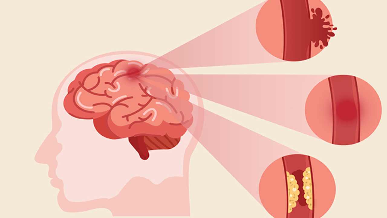Oral Health-Stroke Risk: దంత సమస్యలున్న వారికి స్ట్రోక్ వచ్చే ఛాన్స్!