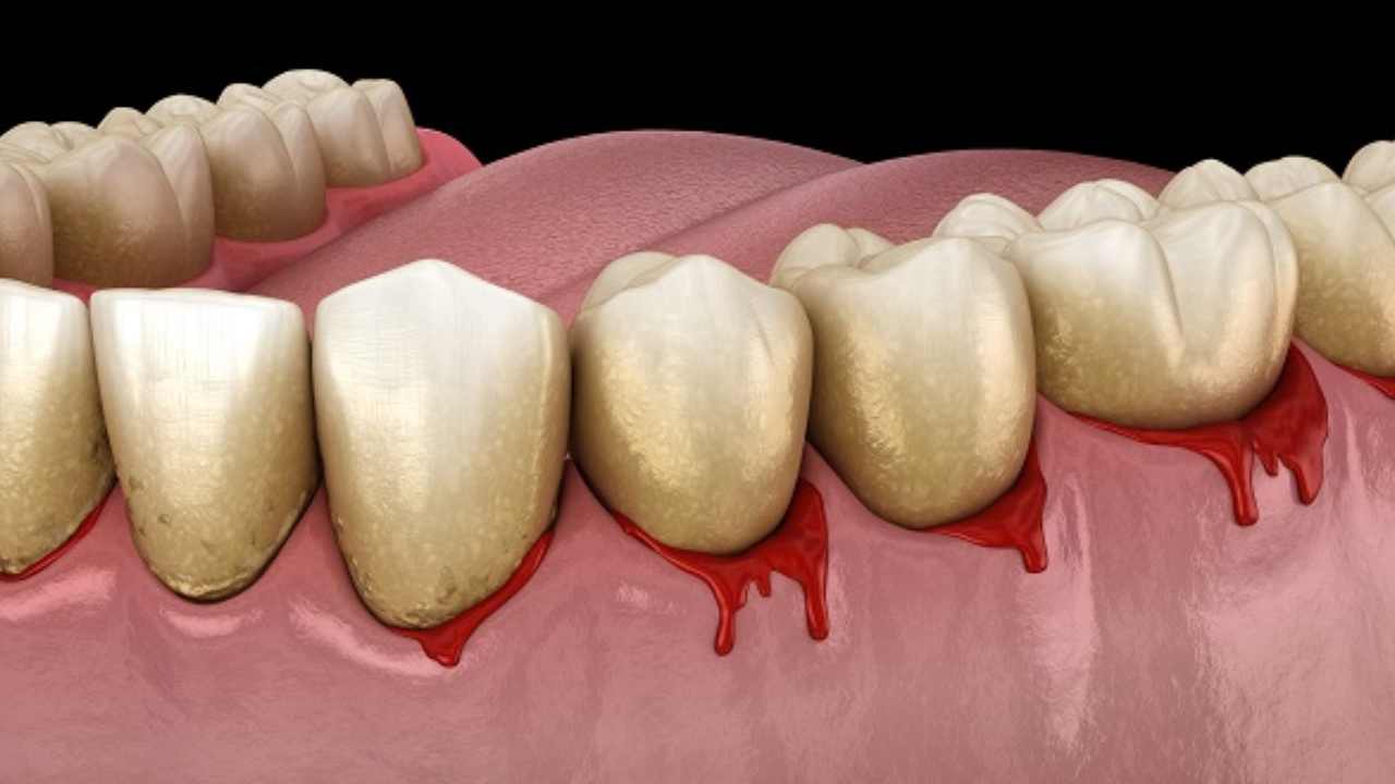 Oral Health-Stroke Risk: దంత సమస్యలున్న వారికి స్ట్రోక్ వచ్చే ఛాన్స్!