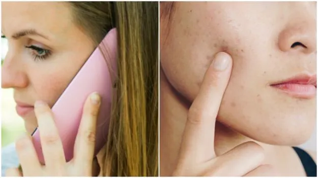 Can Phone Cause Pimples: ఎక్కువ సేపు ఫోన్‌లో మాట్లాడటం వల్ల ముఖంపై మొటిమలు వస్తాయా?