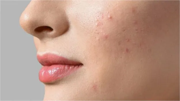 Tips to Get Rid of Pimples: ముఖం మీద మొటిమలను ఎలా నివారించాలో తెలుసా?