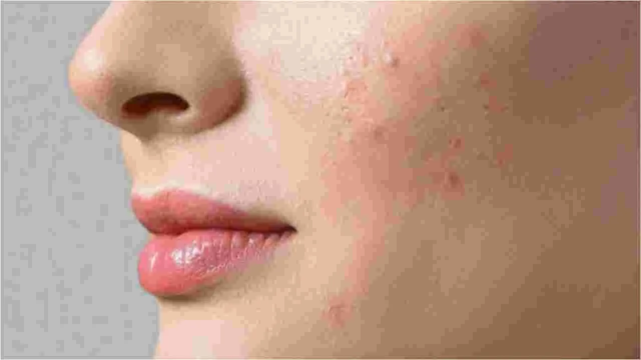 Tips to Get Rid of Pimples: ముఖం మీద మొటిమలను ఎలా నివారించాలో తెలుసా?