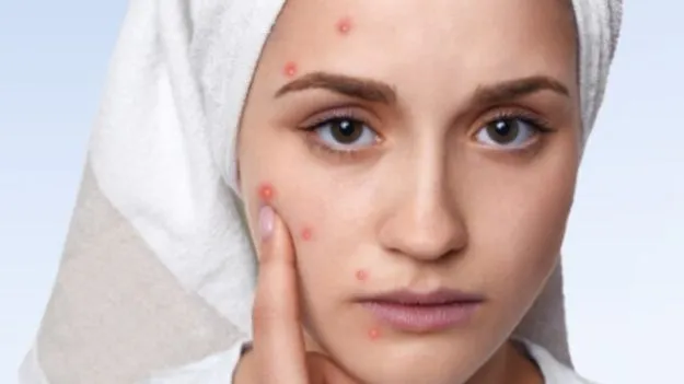 Pimples Reveal Health: ముఖం మీద మొటిమలు.. ఆరోగ్యానికి సంకేతమా?