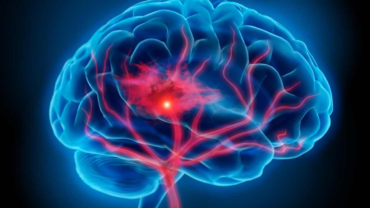 Oral Health-Stroke Risk: దంత సమస్యలున్న వారికి స్ట్రోక్ వచ్చే ఛాన్స్!