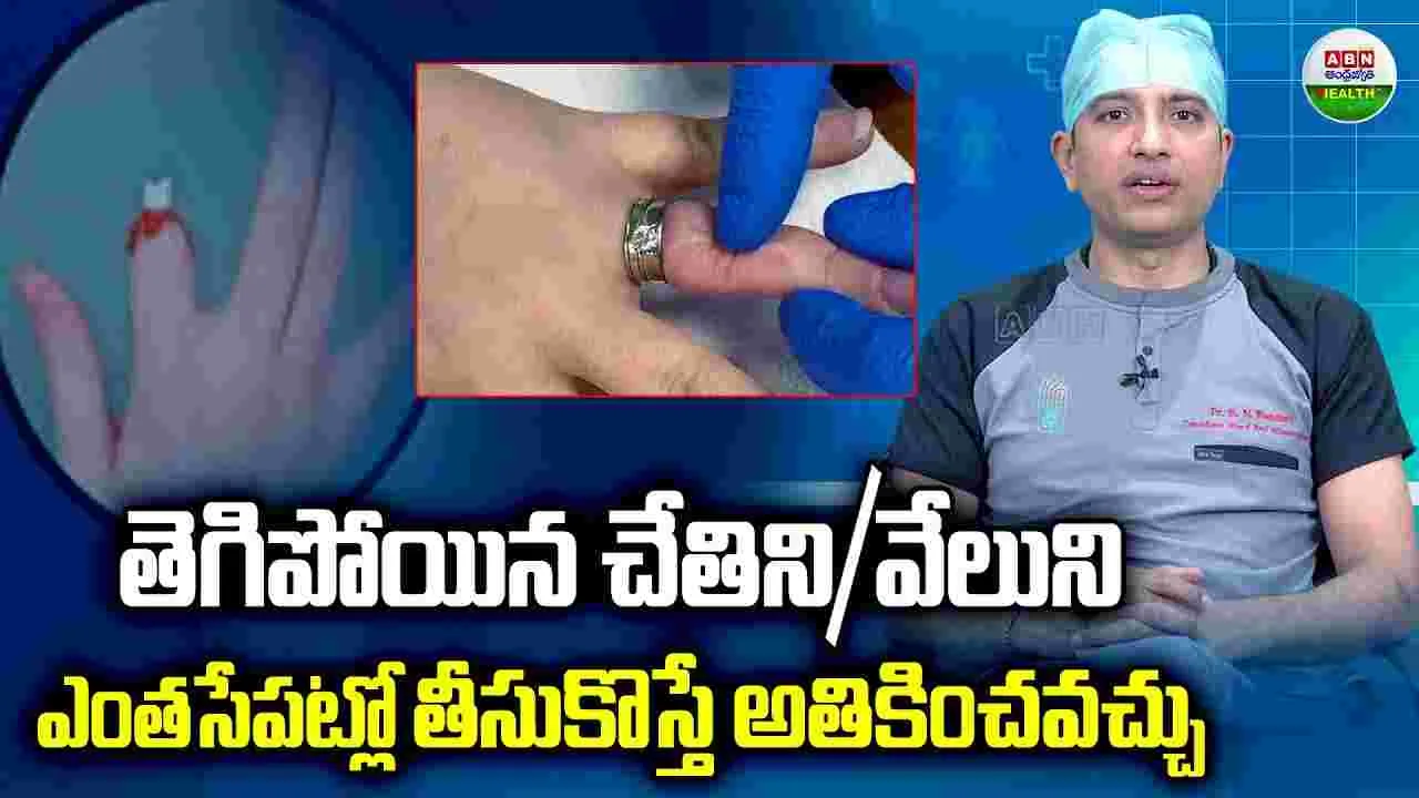 తెగిపోయిన చేతిని/వేలుని ఎంతసేపట్లో తీసుకొస్తే అతికించవచ్చు 