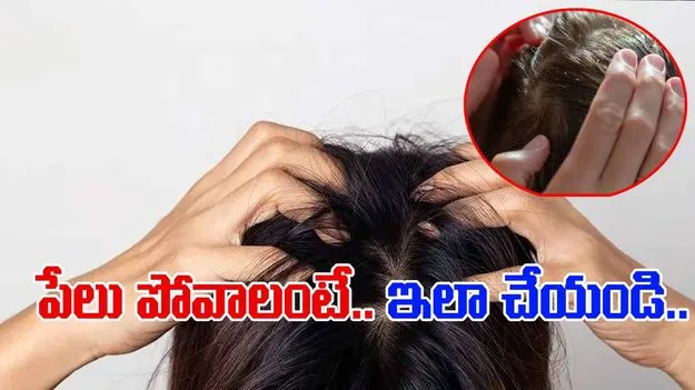 lice prevention: తలలో పేలు పోవాలంటే.. ఈ సింపుల్ చిట్కాలు.. 
