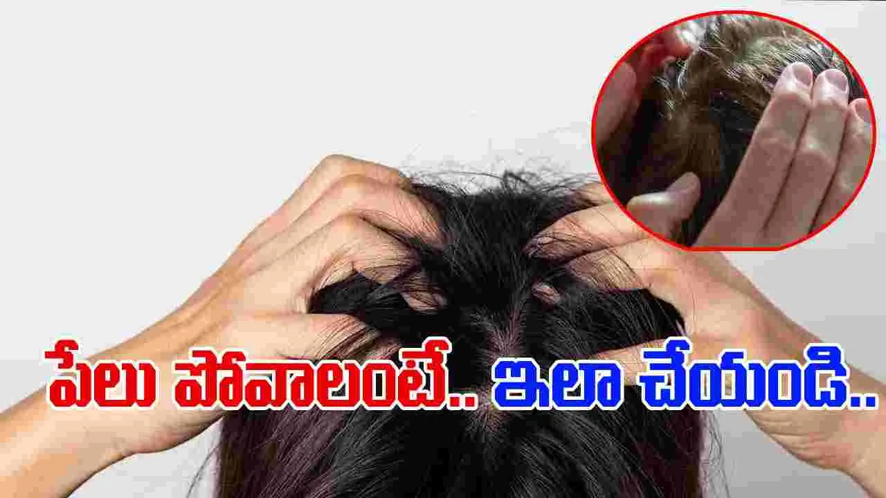 lice prevention: తలలో పేలు పోవాలంటే.. ఈ సింపుల్ చిట్కాలు.. 
