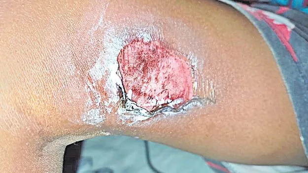 Child Abuse: చదవడం లేదని..బాలుడిని అట్లకాడతో కాల్చిన ట్యూషన్‌ టీచర్‌