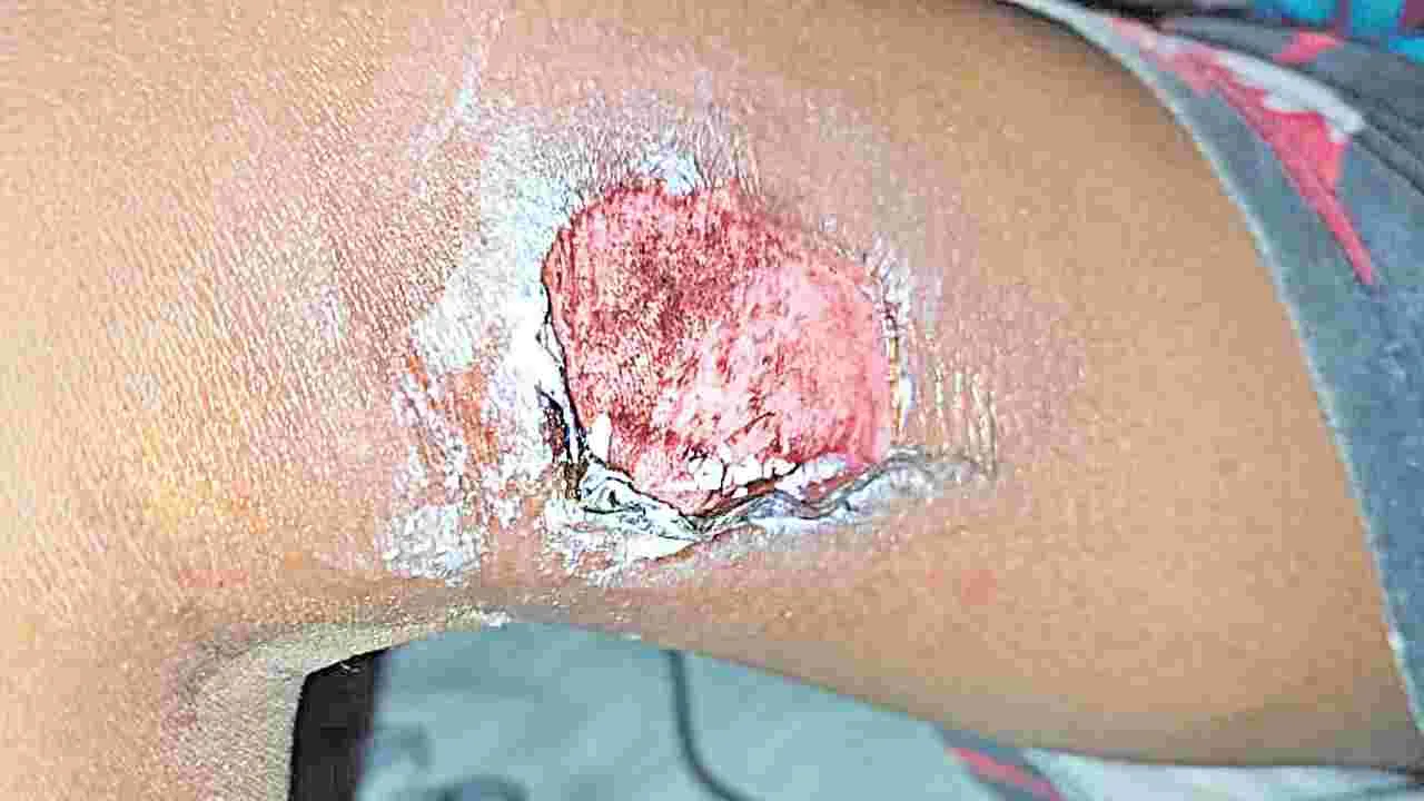 Child Abuse: చదవడం లేదని..బాలుడిని అట్లకాడతో కాల్చిన ట్యూషన్‌ టీచర్‌