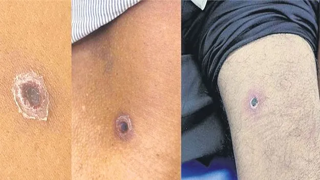 Scrub Typhus Cases: స్క్రబ్‌ టైఫ్‌సకు.. డ్రగ్‌ రెసిస్టెన్స్‌ గండం..!