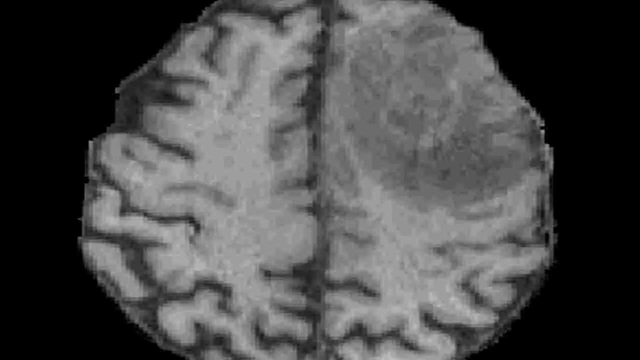 Brain cancer: మెదడు క్యాన్సర్‌ చికిత్సలో ముందంజ