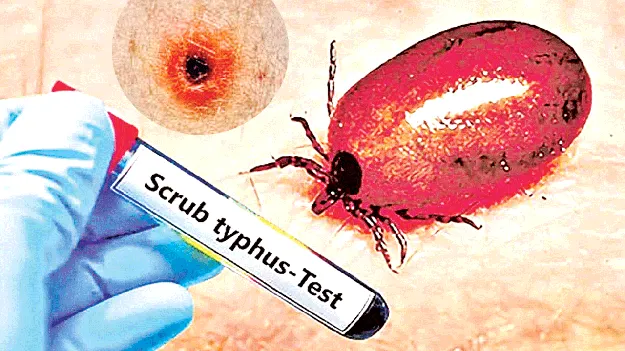 వణికిస్తున్న స్క్రబ్‌టైఫస్‌