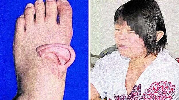 Rare Foot Surgery: పాదమిచ్చిన చెవి!