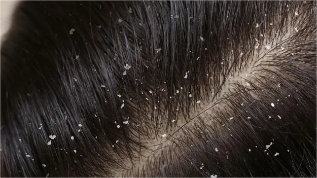 Dandruff Home Remedies: శీతాకాలంలో చుండ్రు పెరుగుతుందా? ఇలా చేయండి.!