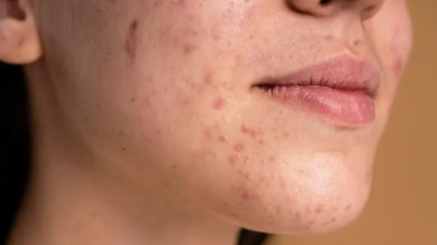 Face Spots Removal: ముఖం మీద మచ్చలను ఇలా వదిలించుకోండి..!