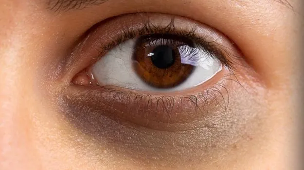 Dark Circles Under Eyes: కళ్ళ కింద నల్లటి వలయాలను ఇలా వదిలించుకోండి