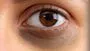 Dark Circles Under Eyes: కళ్ళ కింద నల్లటి వలయాలను ఇలా వదిలించుకోండి