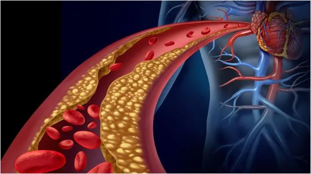 High Cholesterol Symptoms: కొలెస్ట్రాల్ పెరిగినప్పుడు శరీరంలో కనిపించే సంకేతాలు ఇవే.!