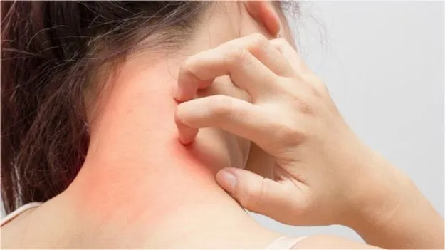 Frequent Skin Itching: చర్మంపై తరచుగా దురద అనిపిస్తే జాగ్రత్త.. ఈ సమస్యకు ముందస్తు సంకేతం కావచ్చు.!