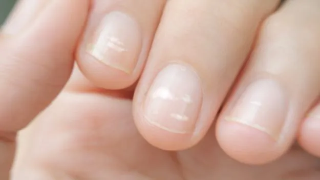 White Spots On Nails: గోళ్ళపై తెల్లటి మచ్చలు ఎందుకు వస్తాయో తెలుసా?