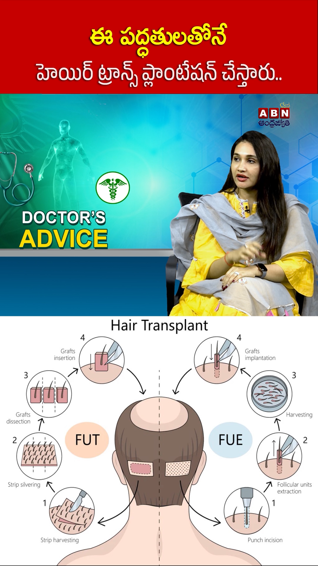 హెయిర్ ట్రాన్స్ ప్లాంటేషన్ ఎలా చేస్తారు!