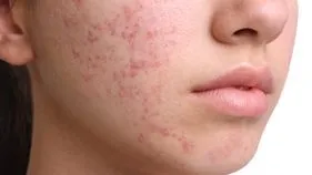 Skin Care Tips In Winter: ముఖంపై మొటిమలు ఉంటే ఇలా చేయండి.. 