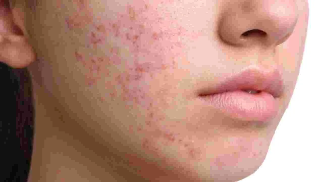 Skin Care Tips In Winter: ముఖంపై మొటిమలు ఉంటే ఇలా చేయండి.. 