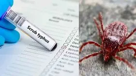 scrub Typhus: వామ్మో స్క్రబ్‌ టైఫస్‌