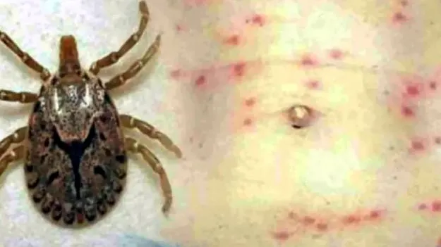 Krishna District: స్క్రబ్‌ టైఫ్‌స్‌తో మరొకరి మృతి