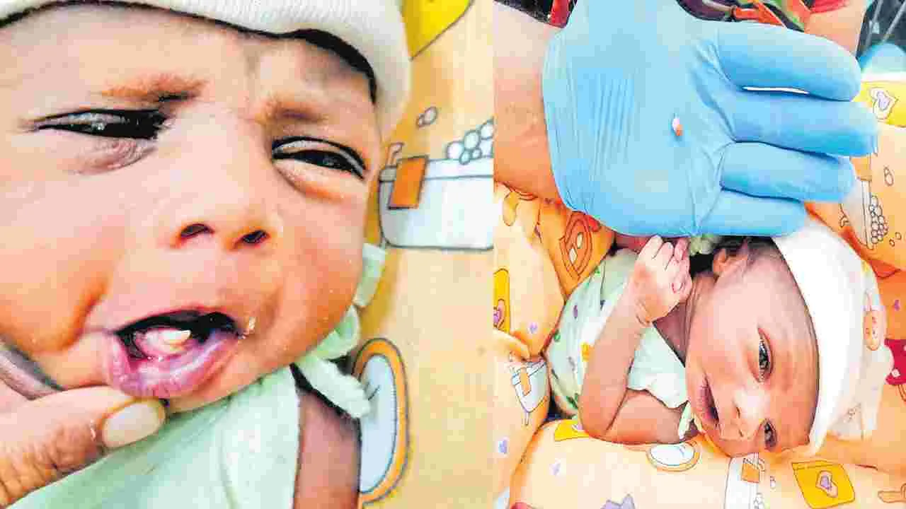 Natal Teeth: పుట్టుకతోనే పాల దంతం..