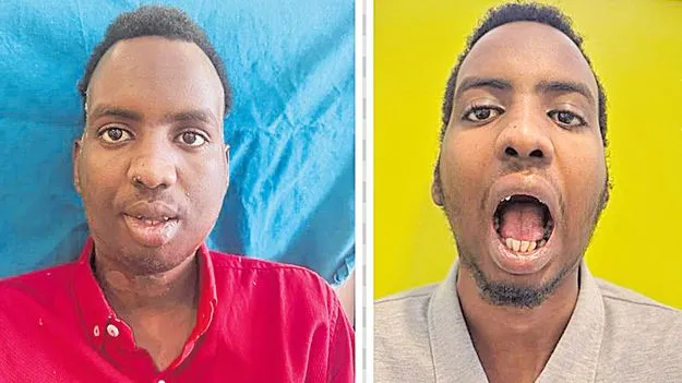 Dental Surgery: 3డీ ఇంప్లాంట్‌ దవడ కీలు మార్పిడి  