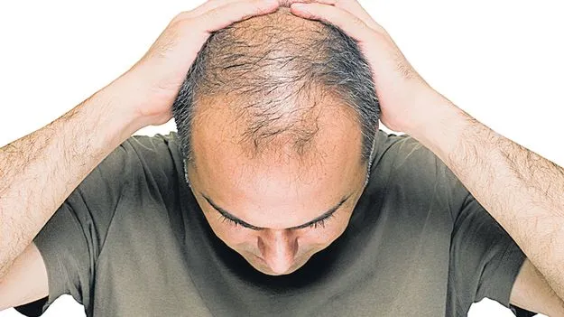 Hair Regrowth: బట్టతలకు కొత్త మందు