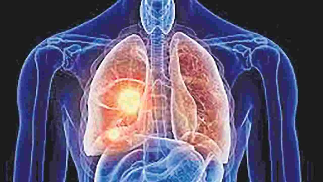 Rising Lung Cancer Cases: ఊపిరితిత్తుల్లో క్యాన్సర్‌ ఉప్పెన!