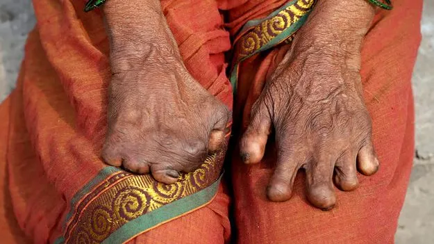 నోటిఫైబుల్‌ వ్యాధిగా కుష్ఠు వ్యాధి