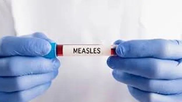 తట్టు మళ్లీ వస్తోంది.. తస్మాత్‌ జాగ్రత్త!  