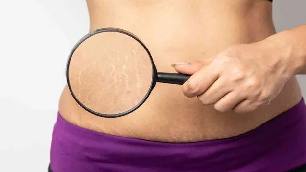 స్ట్రెచ్‌ మార్క్స్‌ పోయేదెలా