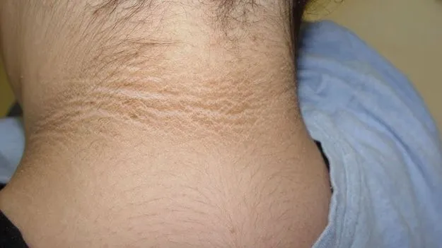 Dark Patches on Neck: మెడ వెనకవైపు చర్మం నల్లగా ఉందా? రిస్క్‌లో పడ్డట్టే..