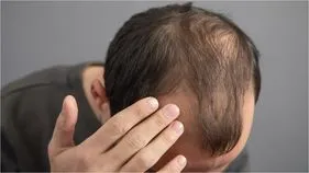 చక్కెర పానీయాలు.. పురుషుల్లో జుట్టు రాలడానికి కారణమవుతున్నాయా?