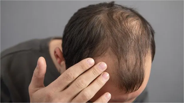 చక్కెర పానీయాలు.. పురుషుల్లో జుట్టు రాలడానికి కారణమవుతున్నాయా?