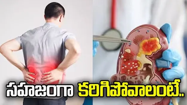 కిడ్నీ స్టోన్స్ సహజంగా కరిగిపోవాలంటే ఏం చేయాలి?