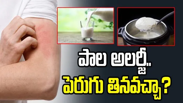 పాల అలర్జీ ఉన్నవారు పెరుగు తినవచ్చా?