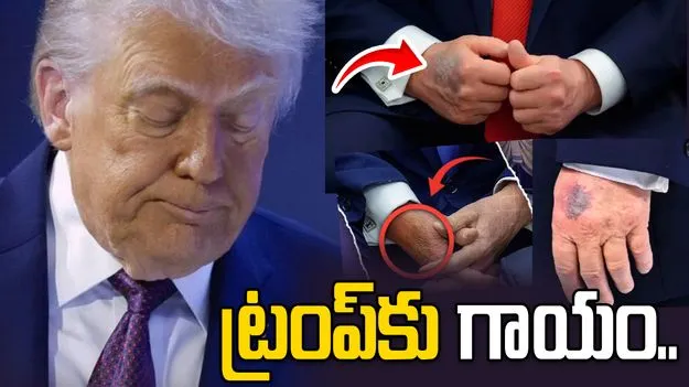 అందుకే నా చేతికి గాయం అయ్యింది: డొనాల్డ్ ట్రంప్