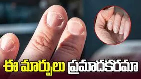 Nail Changes Health Signs: గోళ్లలో కనిపించే ఈ మార్పులు ప్రాణాంతక వ్యాధులకు సంకేతాలా?