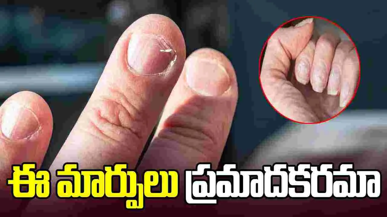 Nail Changes Health Signs: గోళ్లలో కనిపించే ఈ మార్పులు ప్రాణాంతక వ్యాధులకు సంకేతాలా?