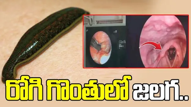 రోగి గొంతులో జలగ.. అలా జరిగి ఉంటే ప్రాణాలు పోయేవి..