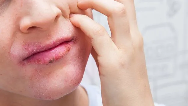 ఎగ్జిమా పెరగదమ్మా...