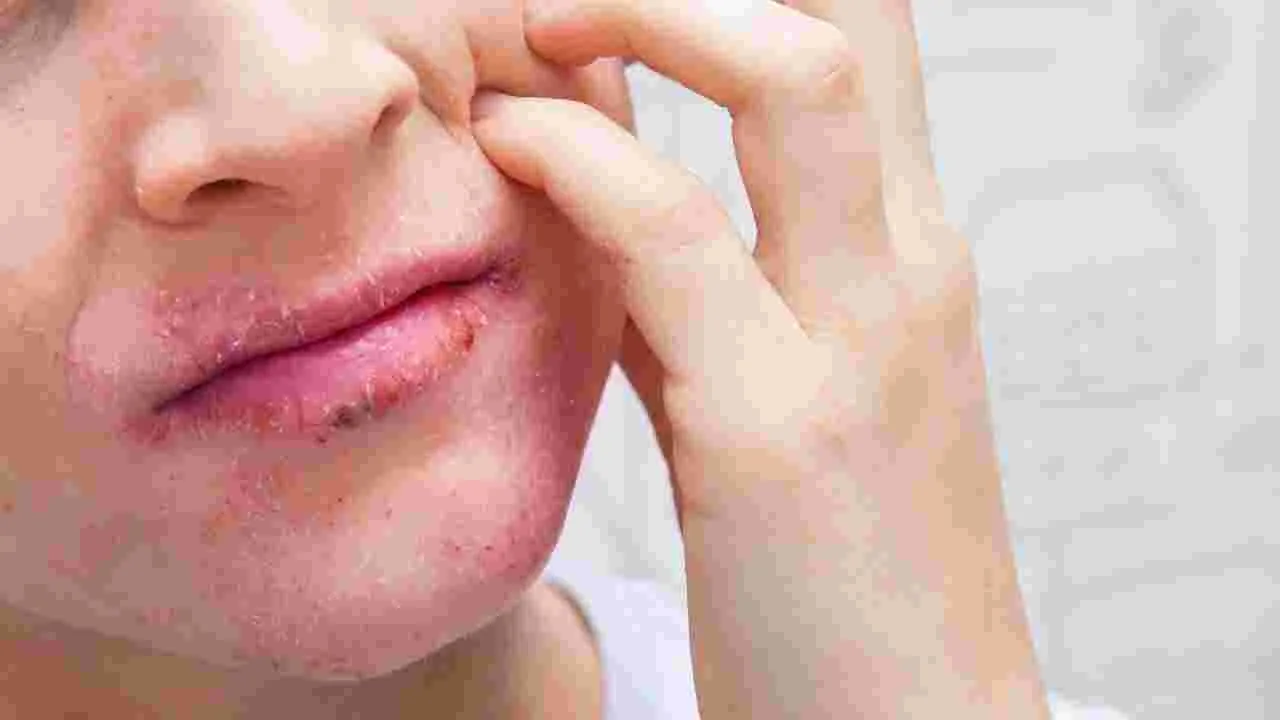 ఎగ్జిమా పెరగదమ్మా...